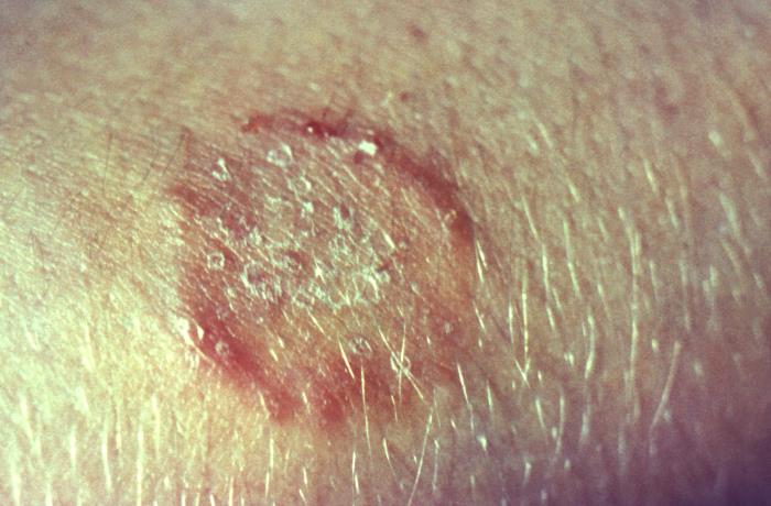 Tinea corporis showing characteristic annular erythematous plaque with central clearing