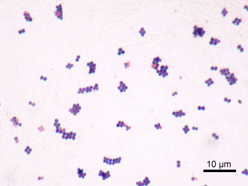 Gram stain of Staphylococcus aureus showing Gram-positive cocci in grape-like clusters