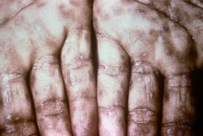 Primary syphilis chancre caused by Treponema pallidum