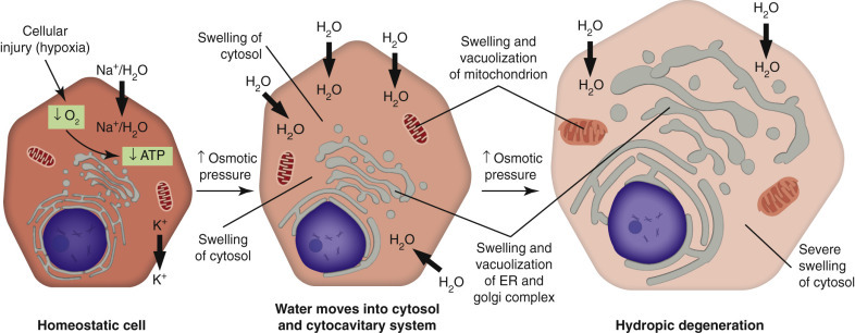 Acute cell swelling process in ischemic injury