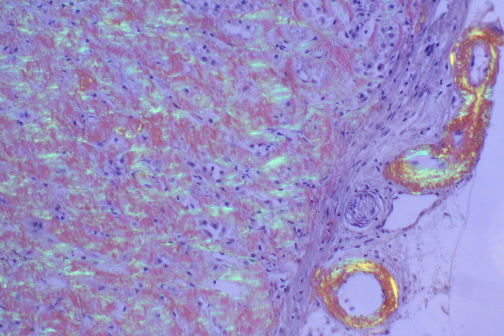 Amyloid deposits stained with Congo red showing apple-green birefringence under polarized light