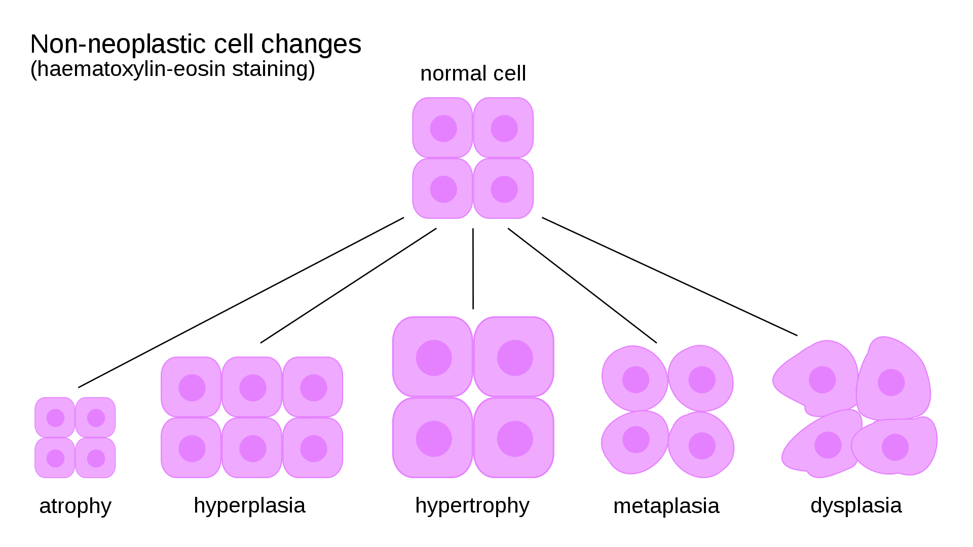 Diagram of cellular adaptations including hypertrophy, hyperplasia, atrophy, and metaplasia