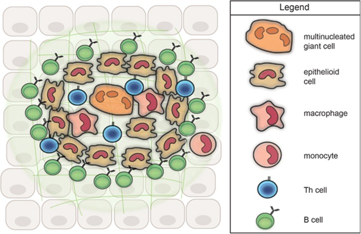 Cellular organization model of a granuloma showing epithelioid cells and giant cells