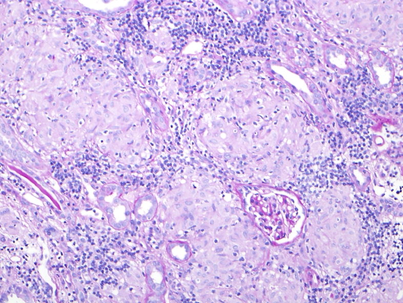 Histology of non-caseating granulomas in sarcoidosis