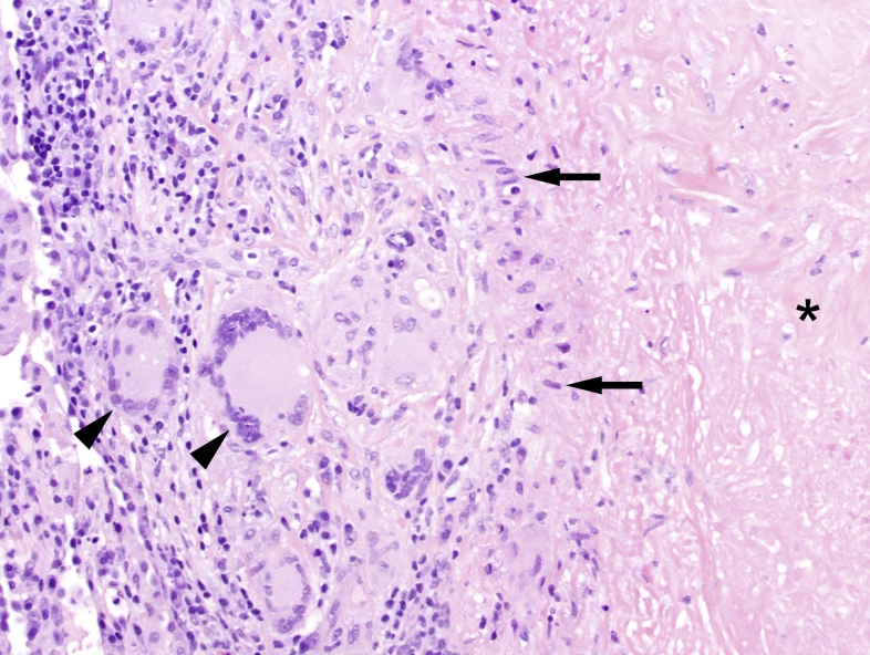 Histology of caseating granuloma in tuberculosis