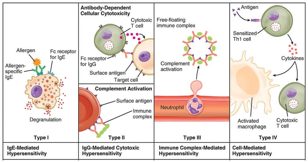 Overview of four types of hypersensitivity reactions