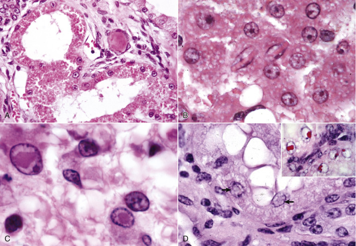 Histologic examples of intracellular accumulations and inclusion bodies
