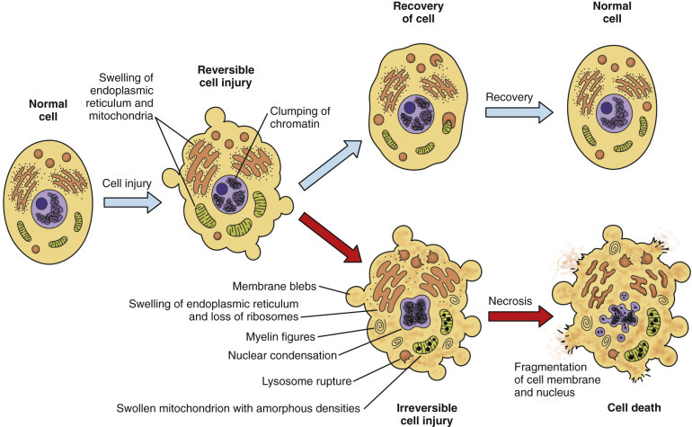 Comparison of normal cell, reversible injury, and irreversible injury morphology