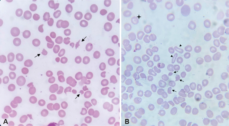 Peripheral blood smear showing schistocytes (fragmented red blood cells)