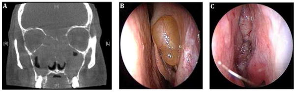 CT scan and endoscopic images showing nasal polyps with mucosal opacification in chronic rhinosinusitis