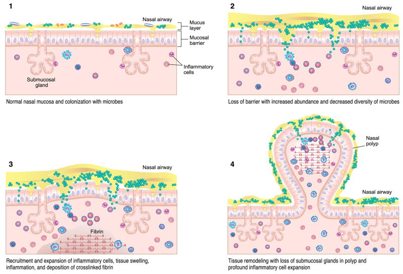 Diagram of CRSwNP pathogenesis showing Th2-driven eosinophilic inflammation with elevated IL-4, IL-5, IL-13 and local IgE production