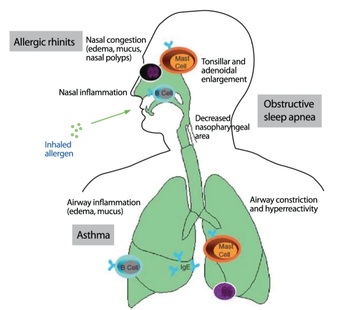 Diagram showing the pathomechanisms of allergic rhinitis including the united airway concept linking upper and lower airway inflammation