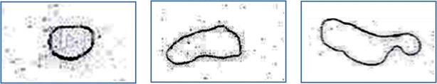 Photograph showing typical wheal forms observed in skin prick testing with various sizes and morphologies