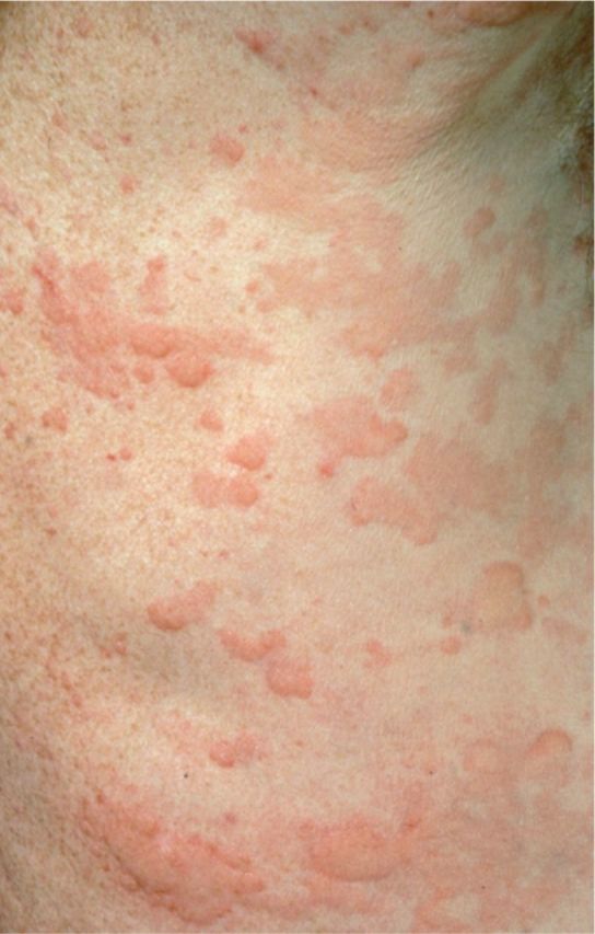 Clinical photograph showing urticarial wheals - raised, erythematous, pruritic lesions characteristic of urticaria