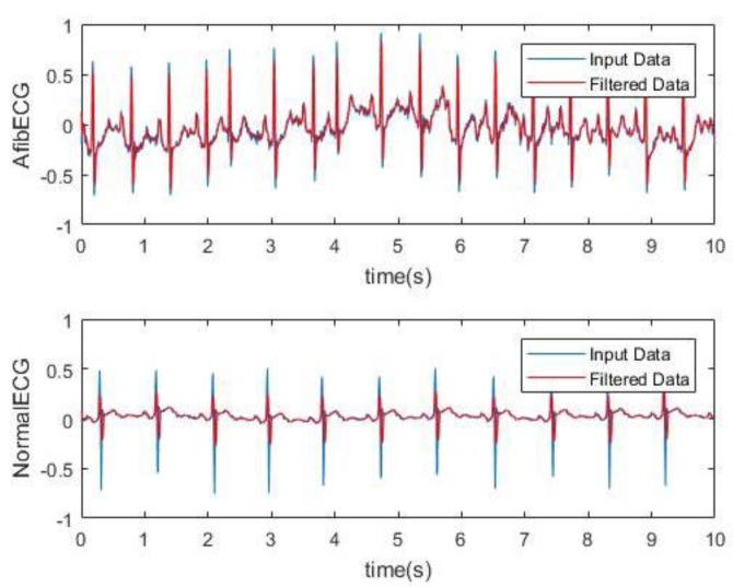 Side-by-side ECG comparison of atrial fibrillation versus normal sinus rhythm