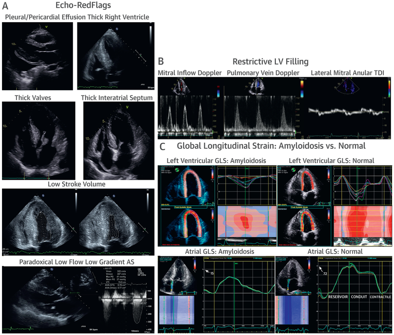 Echocardiographic red flags for cardiac amyloidosis including pericardial effusion, thick RV, restrictive filling, and apical sparing of strain