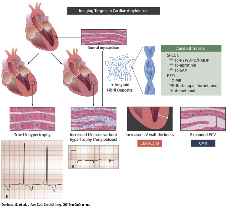 Schematic showing interstitial amyloid deposits and radiotracer targeting mechanisms for cardiac amyloid detection