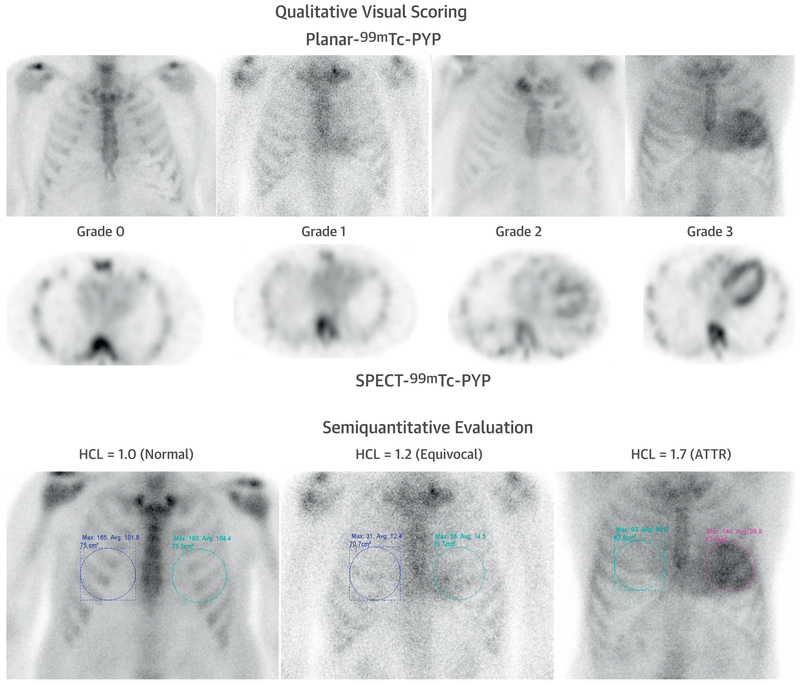 Technetium-99m pyrophosphate scan grading system for ATTR cardiac amyloidosis diagnosis