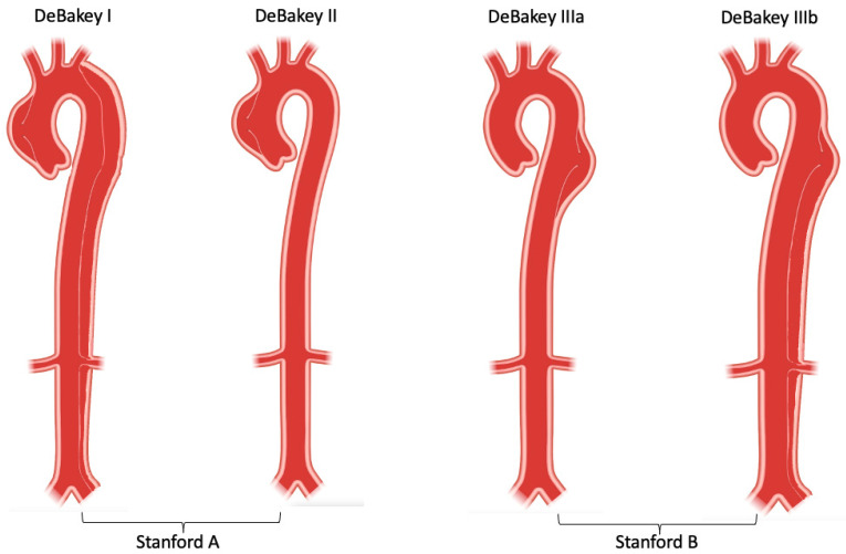 DeBakey and Stanford classification systems for aortic dissection
