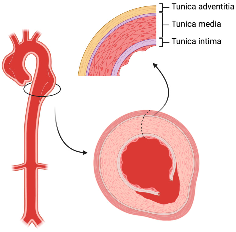 Aortic wall structure showing how intimal tear creates true and false lumens in dissection