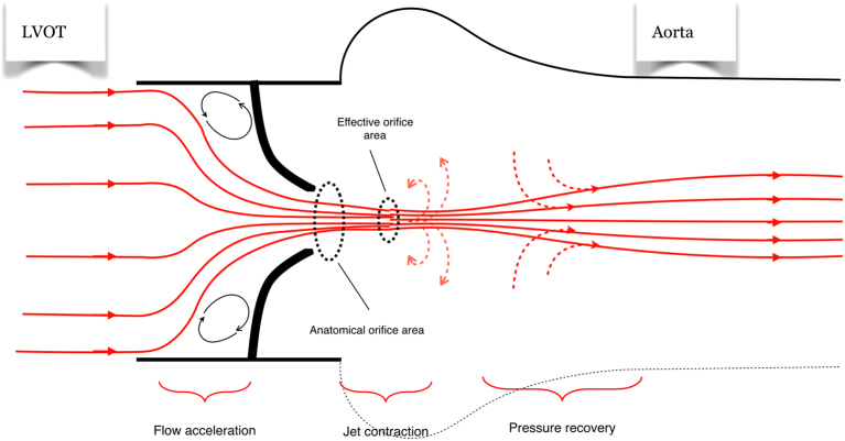 Hemodynamic principles of aortic valve assessment showing flow acceleration, anatomical vs effective orifice, and pressure recovery