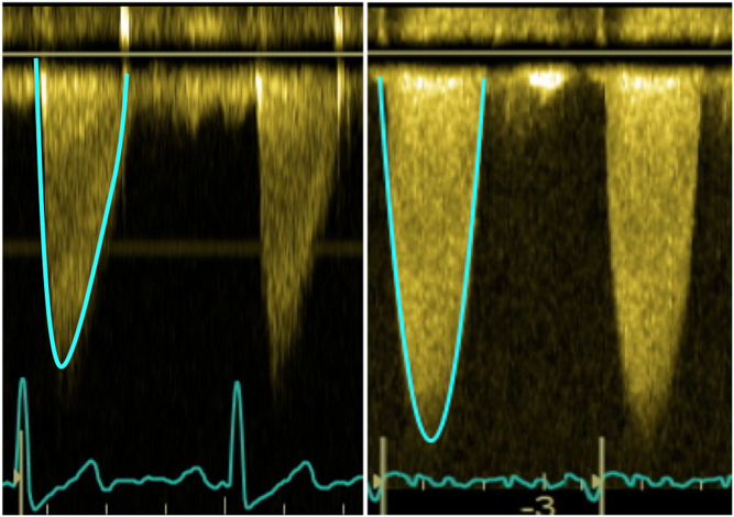 Continuous-wave Doppler waveforms comparing moderate and severe aortic stenosis