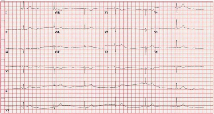 ECG showing third-degree AV block with complete heart block and ventricular escape rhythm