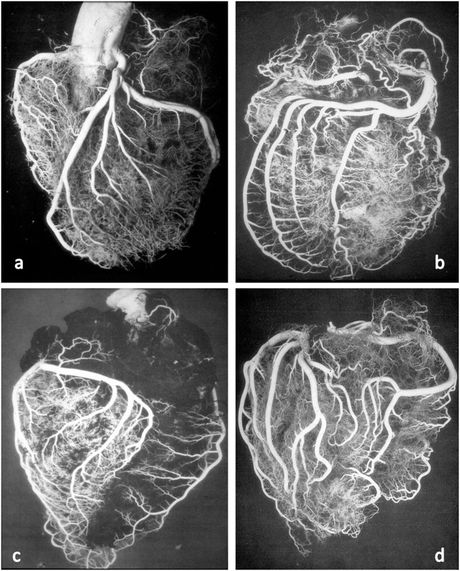 Post-mortem latex casts of coronary arteries showing left and right coronary trees and dominance patterns