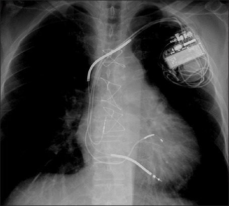 Chest radiograph showing biventricular CRT-D device with three leads in RA, RV, and coronary sinus