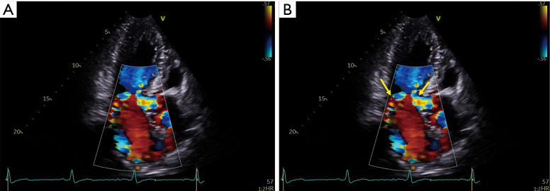 Color Doppler showing LVOT obstruction and posteriorly directed mitral regurgitation in HCM