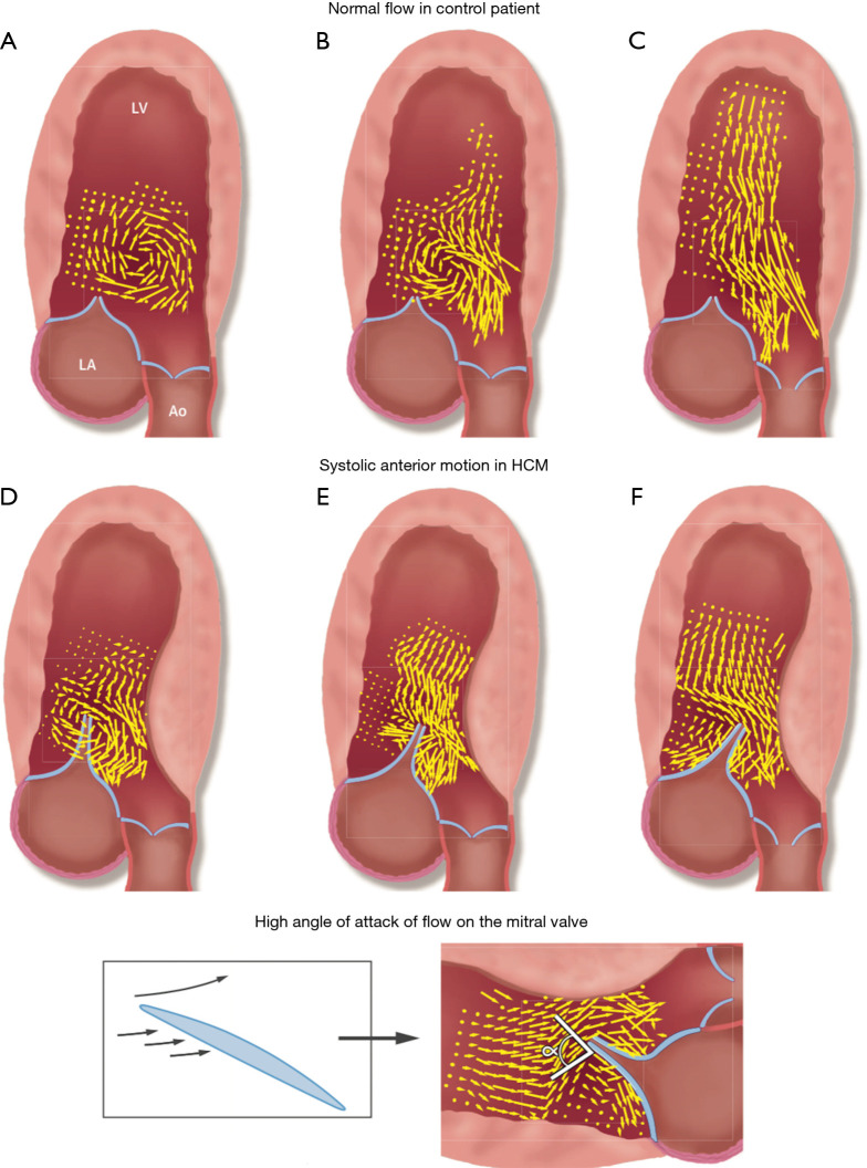 Vector flow mapping comparing normal heart to obstructive HCM showing systolic anterior motion mechanism