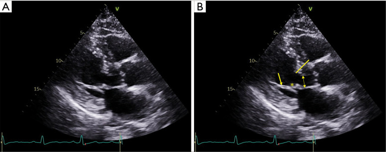 Echocardiographic parasternal long-axis view showing asymmetric septal hypertrophy in HCM