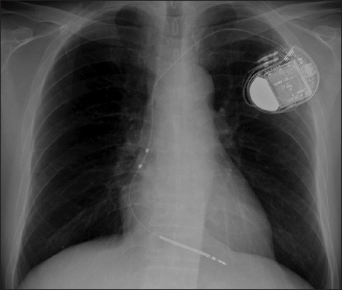 Chest radiograph showing single-chamber ICD with shocking coil in the right ventricle