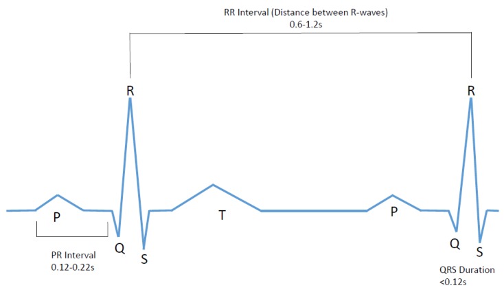 Normal ECG waveform showing P wave, QRS complex, and T wave with labeled intervals