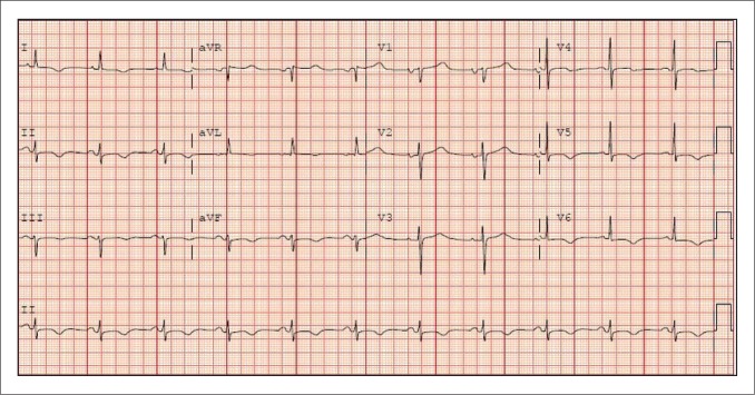 ECG showing T-wave inversions in Stage III pericarditis after treatment