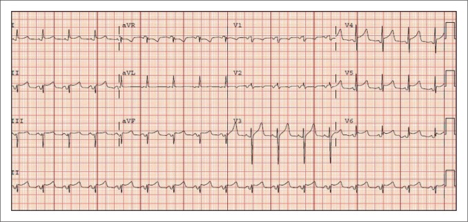 12-lead ECG showing diffuse concave-upward ST elevation and PR depression in acute pericarditis