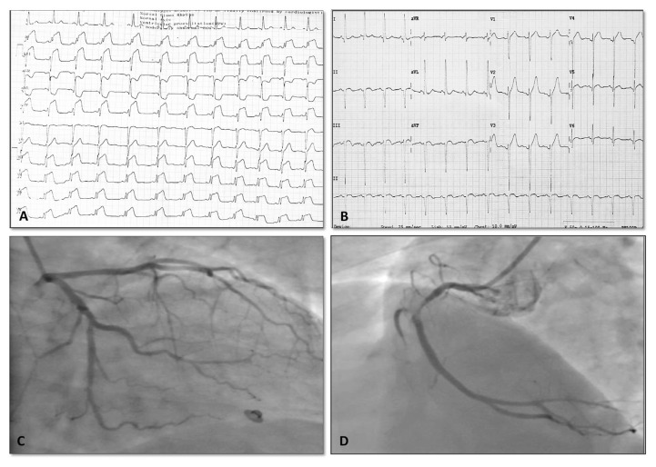 STEMI ECG showing ST-segment elevation with corresponding coronary angiography