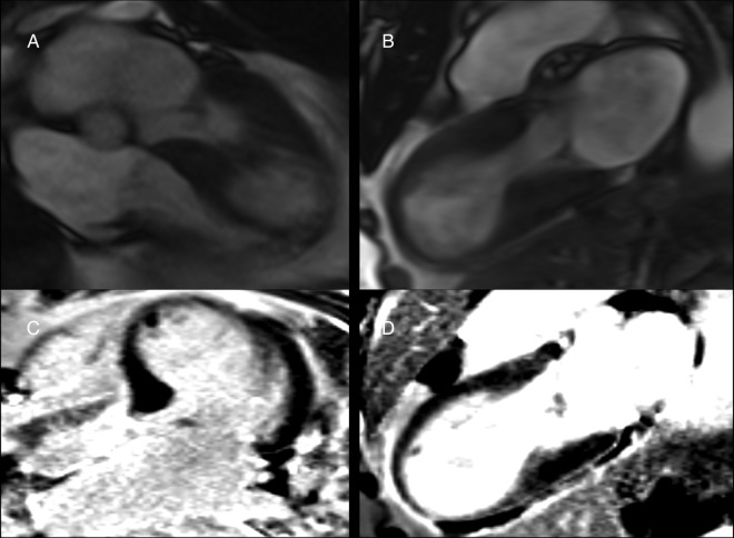 Cardiac MRI showing thinned akinetic apical segments in Takotsubo cardiomyopathy without late gadolinium enhancement