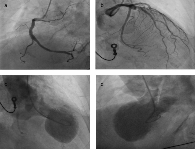 Left ventriculography showing apical ballooning pattern in Takotsubo cardiomyopathy with normal coronary arteries
