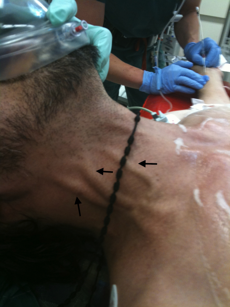Clinical photograph showing distended neck veins in cardiac tamponade