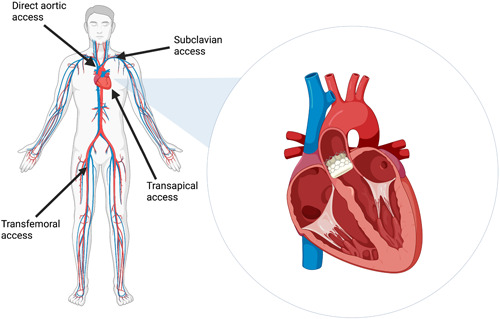 Diagram showing various vascular access routes for TAVR including transfemoral, transapical, and transaortic