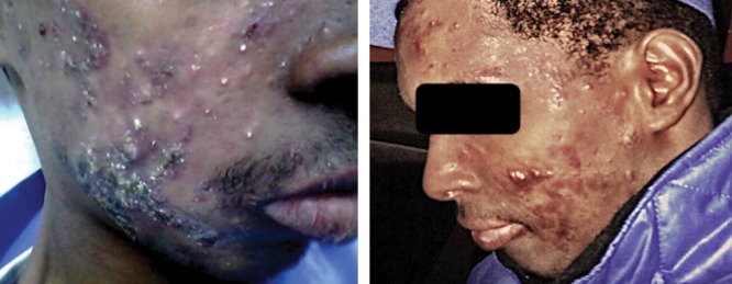 Clinical photograph of severe nodulocystic acne with extensive papules, nodules, and cystic lesions on the face