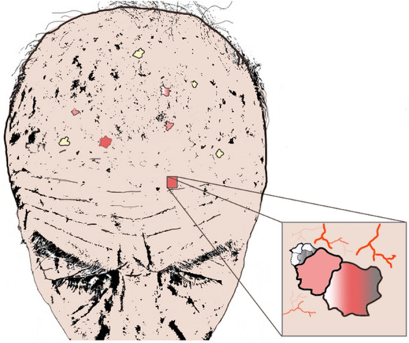 Dermoscopic view of actinic keratoses on sun-damaged scalp showing field cancerization