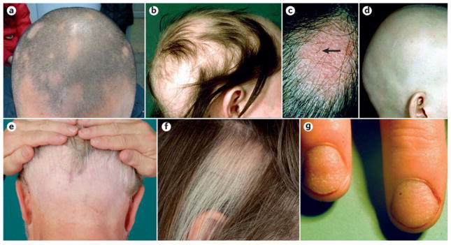 Clinical photographs showing different presentations of alopecia areata including patchy hair loss and exclamation point hairs