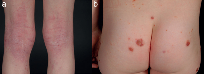 Clinical photographs showing classical flexural and nummular forms of atopic dermatitis in children