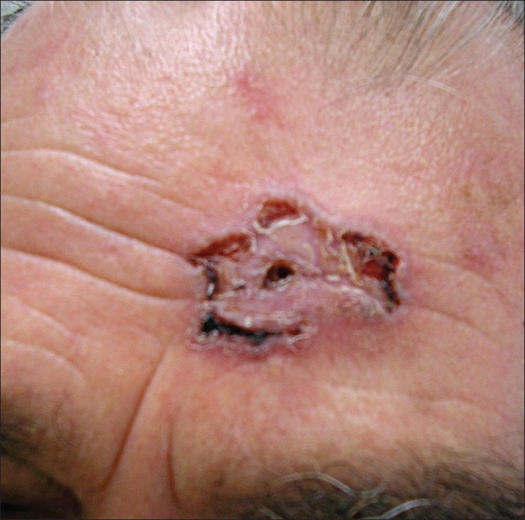 Clinical photograph of morpheaform/infiltrative basal cell carcinoma showing scar-like indurated plaque