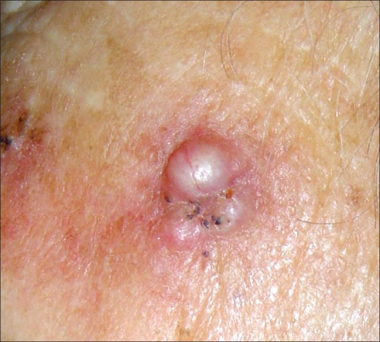 Clinical photograph of nodular basal cell carcinoma showing pearly translucent nodule with telangiectasias