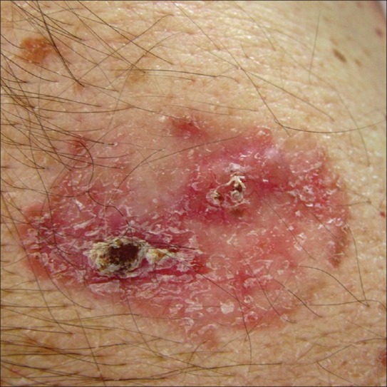 Clinical photograph of superficial basal cell carcinoma showing thin erythematous scaly plaque