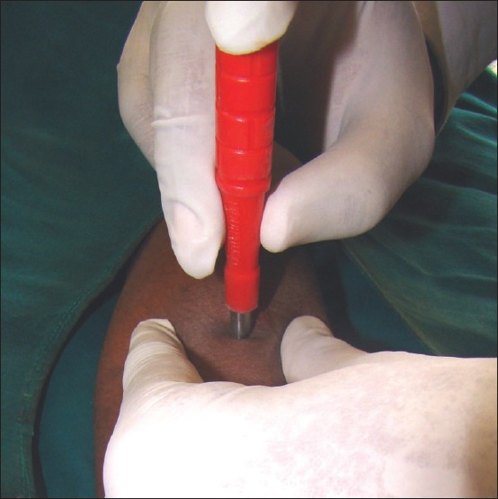 Illustration of punch biopsy technique showing the cylindrical blade being rotated through full skin thickness
