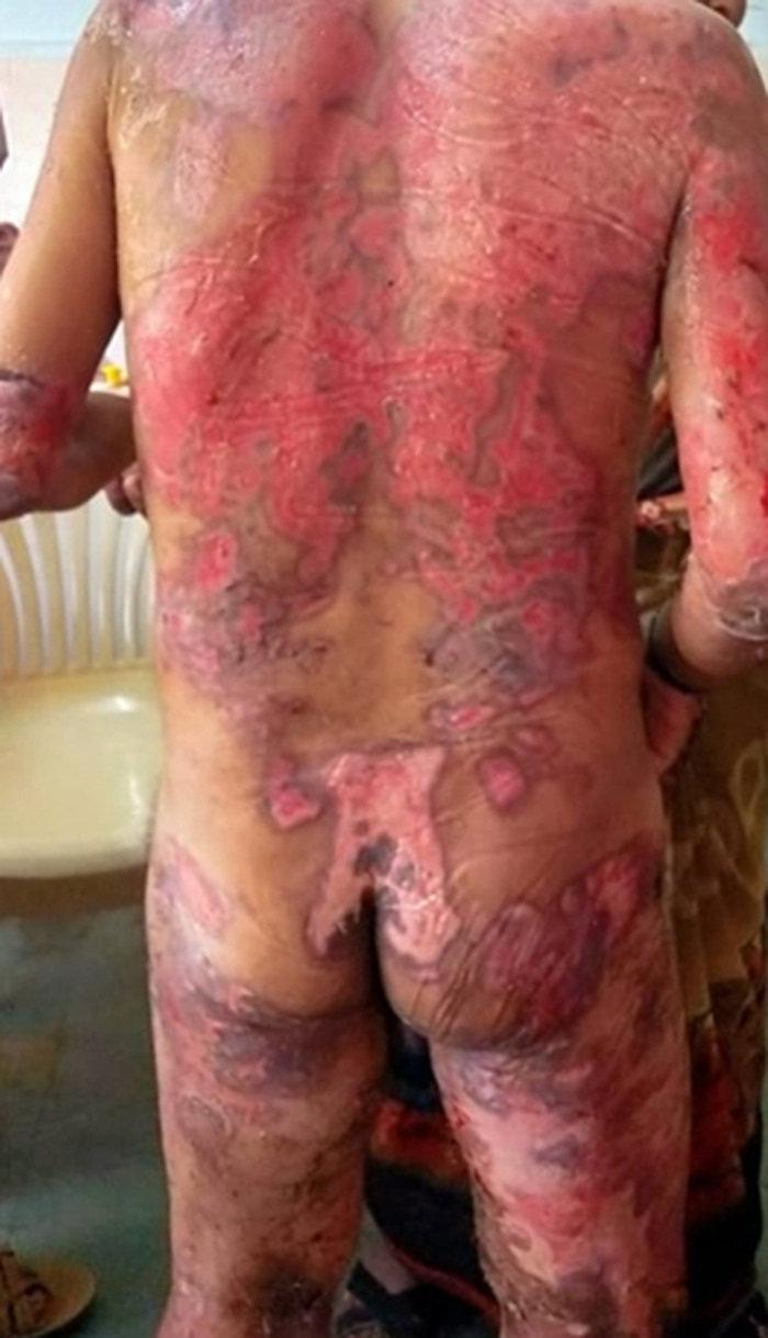 Clinical photograph of bullous pemphigoid showing widespread tense blisters and erosions on the trunk